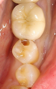 下顎第二小臼歯コンポジットレジン充填２.jpg