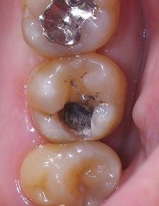 金属イオンによる変色・変質　上顎大臼歯２.jpg