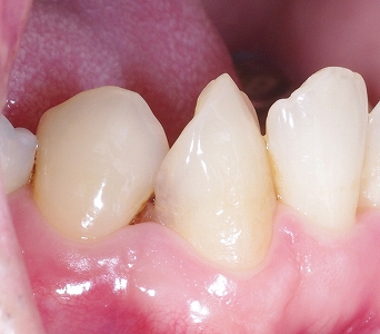 犬歯の捻転による虫歯と歯石沈着１.jpg