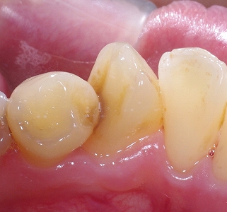 犬歯の捻転による虫歯と歯石沈着２.jpg