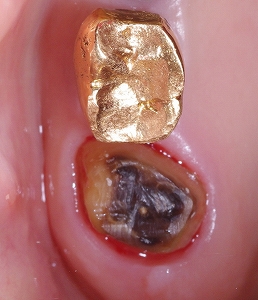 左上第二大臼歯ジルコニア、１.jpg