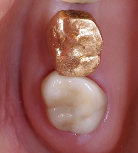 左上第二大臼歯ジルコニア、２.jpg