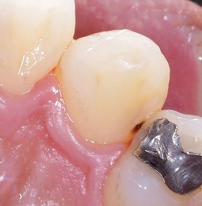 小さな虫歯とアマルガム１.jpg