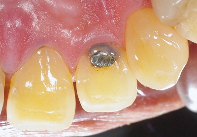 上顎側切歯舌側ＡＦＣ２－１.jpg