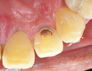上顎側切歯舌側ＡＦＣ２－２.jpg