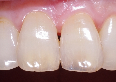 前歯先端磨耗虫歯１.jpg