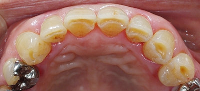 咬み合わせ原因前歯磨耗７－２.jpg