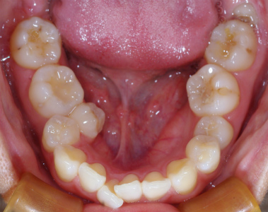 歯列弓の狭窄と第二小臼歯のスペース不足下.jpg