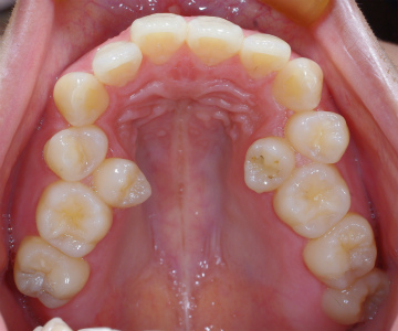 歯列弓の狭窄と第二小臼歯のスペース不足ー上.jpg