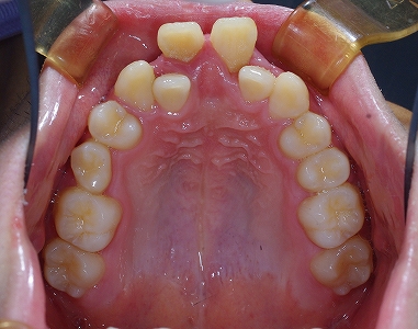 日常生活に支障の歯並び前上.jpg