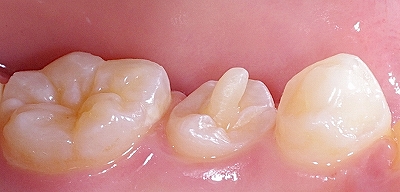 下顎第二小臼歯中心結節舌側.jpg