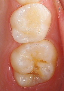 エナメル質形成不全をＣＲ充填、１.jpg