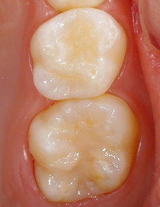 エナメル質形成不全をＣＲ充填、２.jpg