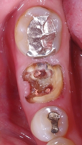 欠損の著しい大臼歯をＥ－ｍａｘ１.jpg
