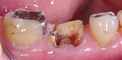 欠損の著しい大臼歯をＥ－ｍａｘ２.jpg