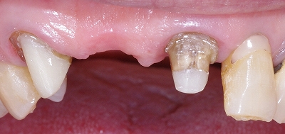 上顎前歯ジルコニアｂｒ70代１.jpg