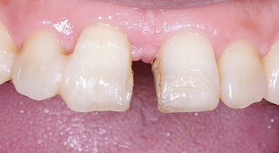 前歯のすき間をセラミックベニア１.jpg