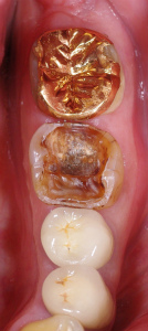 大臼歯の大きな虫歯をセラミックで13,11-1.jpg