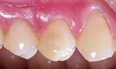 エナメル質形成不全上顎第一小臼歯、、、２.jpg